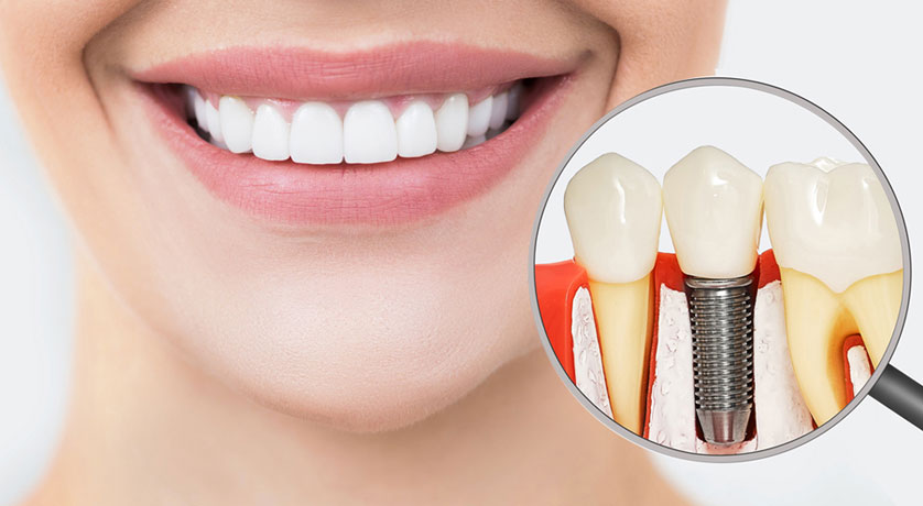 Dental Implants