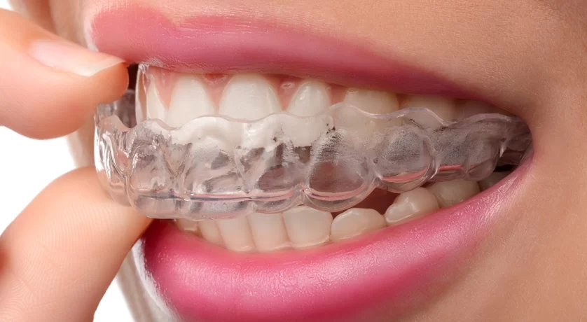 How Invisalign Improves Oral Health Beyond Just Straight Teeth