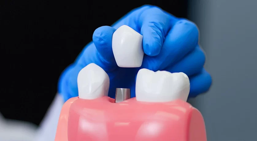 Addressing a Loose Dental Implant: Understanding the Urgency of the Situation