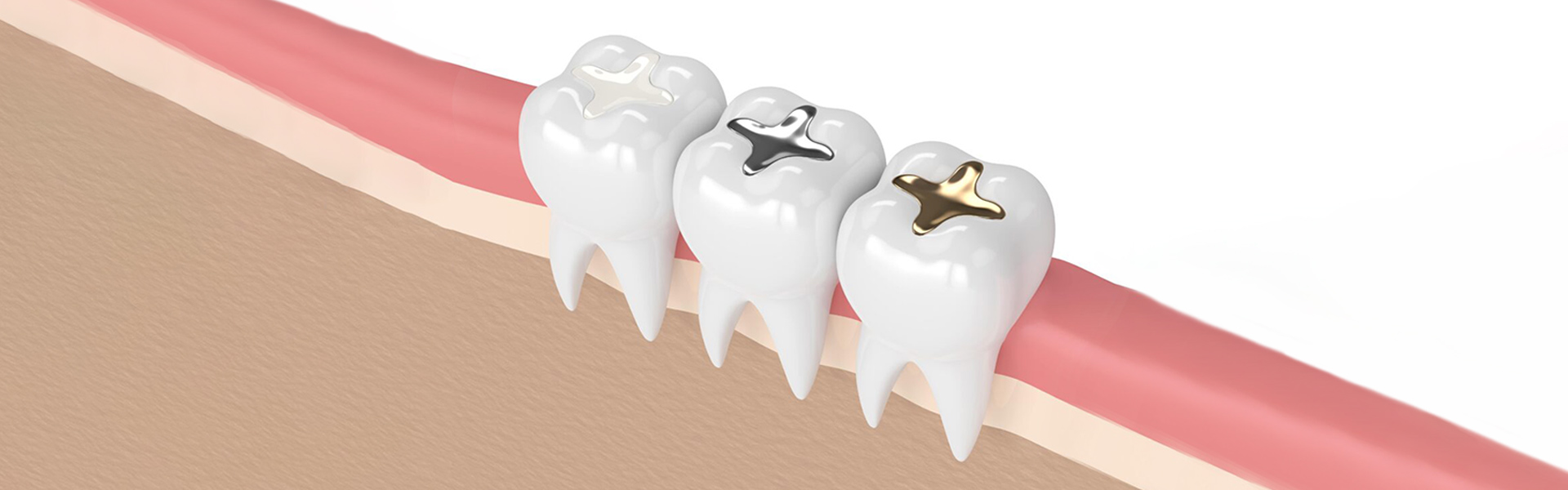 The Pros And Cons Of Silver (Amalgam) Vs. White (Composite) Fillings